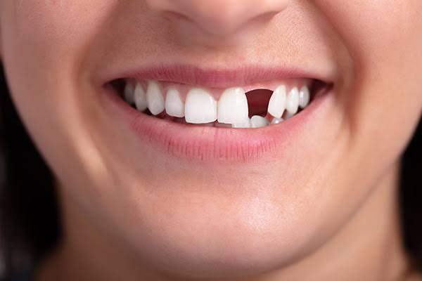 Broken or Missing Tooth ?