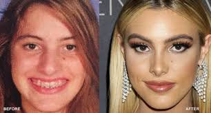 Nose job before and after female. Plastic Surgery Nj Top Plastic Surgeon In Nj