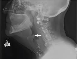 Image result for Epiglottitis