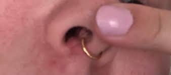 Bumps On Both Sides Of Septum Piercing 5 6 Months Old I Ve Had These Bumps For As Long As I Can Remember I Still Get Crusties Everyday And I Still Get A Little