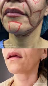 🎁 𝑸𝒖𝒊𝒆𝒓𝒆𝒔 𝒖𝒏 𝒓𝒆𝒋𝒖𝒗𝒆𝒏𝒆𝒄𝒊𝒎𝒊𝒆𝒏𝒕𝒐𝒇𝒂𝒄𝒊𝒂𝒍 𝒅𝒆  𝒂𝒃𝒐𝒓𝒅𝒂𝒋𝒆 𝒎𝒊𝒏𝒊𝒎𝒐 ? ⇢ Aplicable para cualquier edad.  𝐑𝐞𝐣𝐮𝐯𝐞𝐧𝐞𝐜𝐢𝐦𝐢𝐞𝐧𝐭𝐨 𝐟𝐚𝐜𝐢𝐚𝐥 𝐜𝐨𝐧 𝐭𝐞𝐜𝐧𝐨𝐥𝐨𝐠𝐢𝐚  𝐅𝐚𝐜𝐢𝐚𝐥 𝐑𝐞𝐭𝐫𝐚𝐜𝐭𝐢𝐨𝐧 𝘕𝘰 𝘪𝘯𝘤𝘪𝘴𝘪𝘰𝘯𝘦𝘴 𝘥𝘦  𝘭𝘪𝘧𝘵𝘪𝘯𝘨 Radiofrecuencia Facial ...