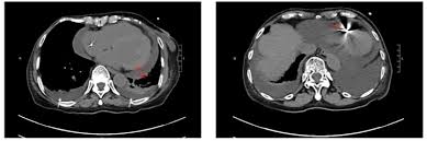 Covid 19 Case Serves As Warning On Cardiac Involvement Medpage Today