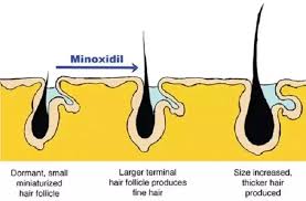 Minoxidil (rogaine) is the only topical ingredient approved by the food and drug administration (fda) for regrowing hair. How Much Hair Fall Is Normal After Using Minoxidil Quora