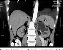 Image result for Genitourinary Tuberculosis
