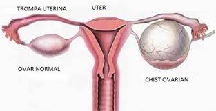 Chistul ovarian este o tumoare benignă (neoplasm). Chistul Ovarian Ce Este Simptome Complicatii Si Tratament Medlife
