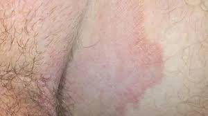 Jock Itch That Won T Go Away Causes And Treatments