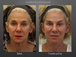 The results are achieved by inserting threads with tiny hooks in them, that pull the skin around the corner of the eyes. Brow Lift Case 3622 New Orleans Premier Center For Aesthetics And Plastic Surgery