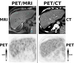 And other kinds will show only on a bone scan but not a pet scan. Pet Mri Versus Pet Ct In Oncology A Prospective Single Center Study Of 330 Examinations Focusing On Implications For Patient Management And Cost Considerations Springerlink