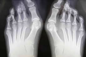 </b>small joints of the feet, wrists, and hands are frequently involved by a reduction of osteoporosis; How Rheumatoid Arthritis Affects Each Part Of The Body