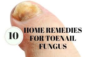 natural home remes for toenail fungus
