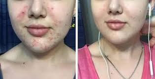 Miracle Acne Treatment Is Now Available To Buy Over The Counter At Superdrug And The Results Are Jaw Dropping