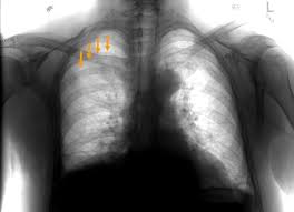 Image result for Pneumothorax