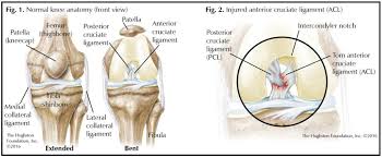What is access control list? Acl Tears In Teens Hughston Clinic