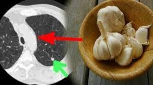 Makanlah bawang putih sebelum tidur untuk menyembuhkan flu dan meredakan hidung tersumbat. Makan Bawang Putih Sebelum Tidur Dan Rasakan Khasiat Ini Youtube