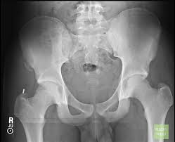 The anterior superior iliac spine (asis) is the most anterior part of the iliac crest. Avulsion Fracture Anterior Superior Iliac Spine Radiology Case Radiopaedia Org
