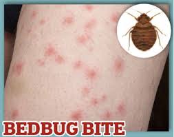 Image result for bedbugs bites