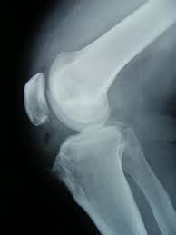 Arthroscopic Excision Of A Huge Ununited Ossicle Due To Osgood Schlatter Disease In An Adult Patient Journal Of Orthopaedic Case Reports