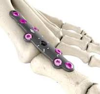 MTP Long / Revision Plates | Novastep