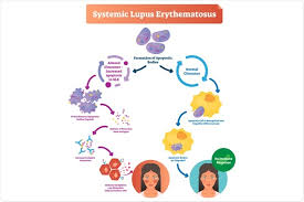 Patients with suspected or confirmed systemic lupus erythematosus (sle) undergo laboratory tests for multiple reasons. What Is Lupus