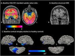 Geschwind Syndrome In Frontotemporal Lobar Degeneration Neuroanatomical And Neuropsychological Features Over 9 Years Sciencedirect