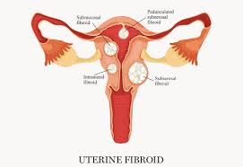 Subserosal fibroids project to the outside of the uterus. Non Surgical Approach To Uterine Fibroid Management Singhealth