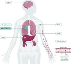 Lung cancer is the leading cause of cancer deaths in both women and men in the united states, canada, and china. Small Cell Lung Cancer Nature Reviews Disease Primers