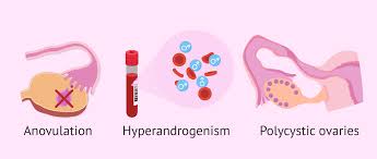 Anovulation/oligoovulation, hyperandrogenism, and polycystic ovaries revealed by sonogram. Diagnosis Of Pcos With Rotterdam Criteria