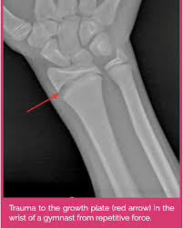 Image result for Growth Plate