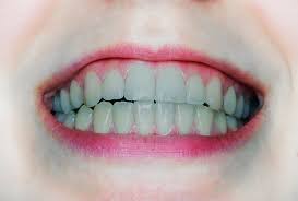 These are the top educational shows. Gray Teeth Causes Treatment Self Care Complications