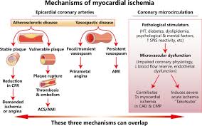 Image result for Myocardial Infarction Stabilization