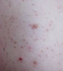 Image result for Keratosis pilaris