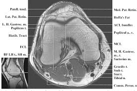 Located on the posterolateral aspect of the knee joint, extending from the popliteus muscle to the medial aspect of the fibula. Figure 2 From Normal Mr Imaging Anatomy Of The Knee Semantic Scholar