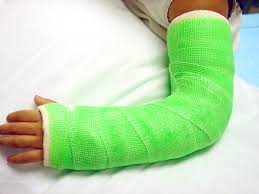 Image result for Long Arm Cast