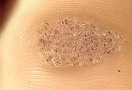 Image result for brown patches on the feet