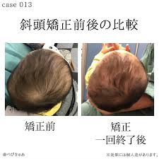 赤ちゃんの頭の形矯正  斜頭症についての様々な情報をお伝えいたします。  斜頭症矯正ならべびきゅあ