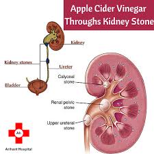 Apple Cider Vinegar Helps To Dissolve The Stones For The Few People Who Have A High Level Of Certain Ch Kidney Stones Remedy Treat Kidney Stones Kidney Stones