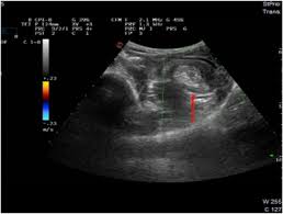 We did not find results for: Colocolic Intussusception In A Child Due To A Sigmoid Polyp Sciencedirect