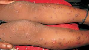 Image result for Papular urticaria