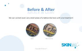 Lift online training is here! Non Laser Tattoo Removal System Business Presentation Ppt Download