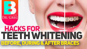 This is just a video about how i've been keeping my teeth white while wearing braces. Braces Hacks To Keep Your Teeth White Teeth Whitening With Braces And Invisalign Youtube