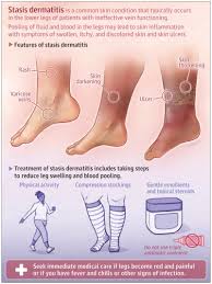 Image result for Stasis Dermatitis