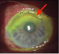 Image result for Gonococcal Conjunctivitis