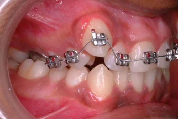 Điều chỉnh chỉnh nha định kỳ