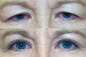 blefaroplastia e a cirurgia de remocao do excesso de pele nas palpebras superiores ou inferiores que melhora o aspec blefaroplastia cirurgia plastica palpebras