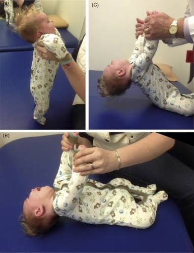 Infantile Hypotonia - an overview | ما هو نقص توتر العضلات عند الرضع؟
