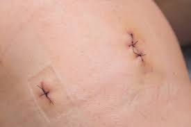 Sterilize the cut with an antiseptic. Shoulder Surgery Stitches Novocom Top
