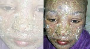 Tekstur kulit yang kulit jenis ini memiliki kandungan minyak semula jadi. Wajah Ibu Ini Membusuk Akibat Alergi Obat Health Liputan6 Com