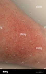 Image result for Photodermatitis