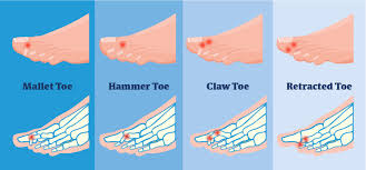 I've heard of curves to the left and right but i haven't read about a downward curve. I Have Curled Toes Is There Something Wrong Feet First Clinic