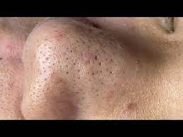 Satisfying Relaxing With Sac Dep Spa Video 085 Acne Youtube Zit Popping Videos Blackheads Popping Popping Blackheads Youtube Videos